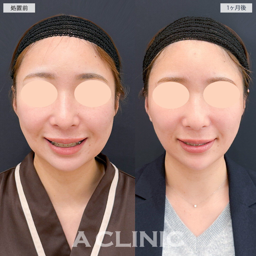 1day小顔脂肪吸引とバッカルファット除去術で左右非対称のお顔の余白を改善！処置前と1ヶ月後の症例です(20代女性)