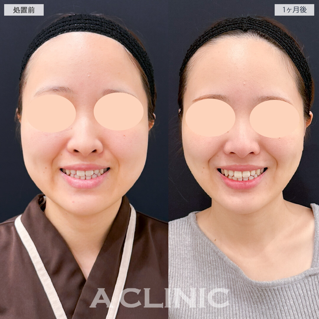1day小顔脂肪吸引とバッカルファット除去術でお顔のバランスに合わせて不要な脂肪のみスッキリさせることができました！処置前と1ヶ月後の症例です(20代女性)