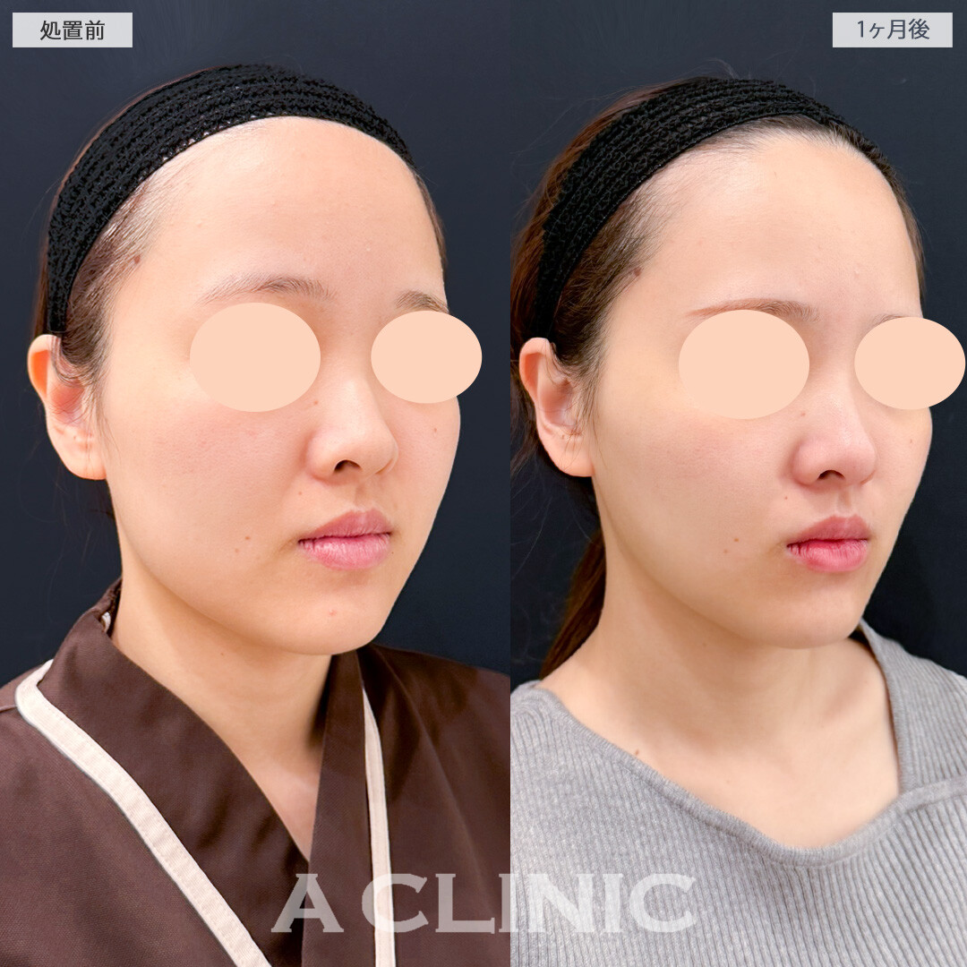 1day小顔脂肪吸引とバッカルファット除去術でお顔のバランスに合わせて不要な脂肪のみスッキリさせることができました！処置前と1ヶ月後の症例です(20代女性)