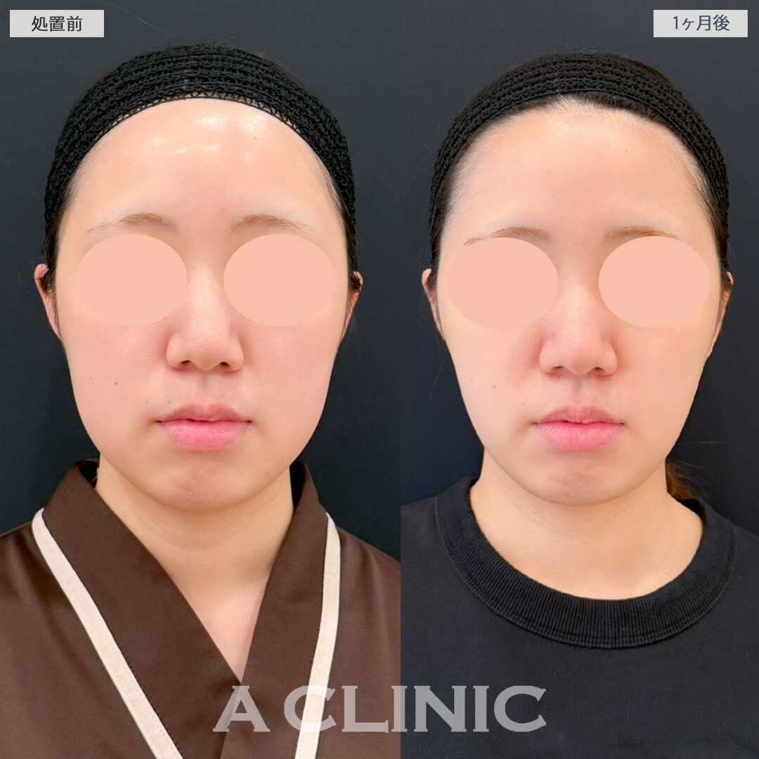 1day小顔脂肪吸引とバッカルファット除去術で口横の膨らみを抑えて小顔効果抜群！処置前と1ヶ月後の症例です(20代女性)