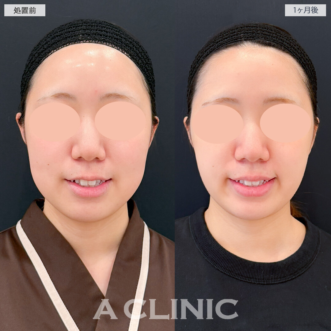 1day小顔脂肪吸引とバッカルファット除去術で口横の膨らみを抑えて小顔効果抜群！処置前と1ヶ月後の症例です(20代女性)