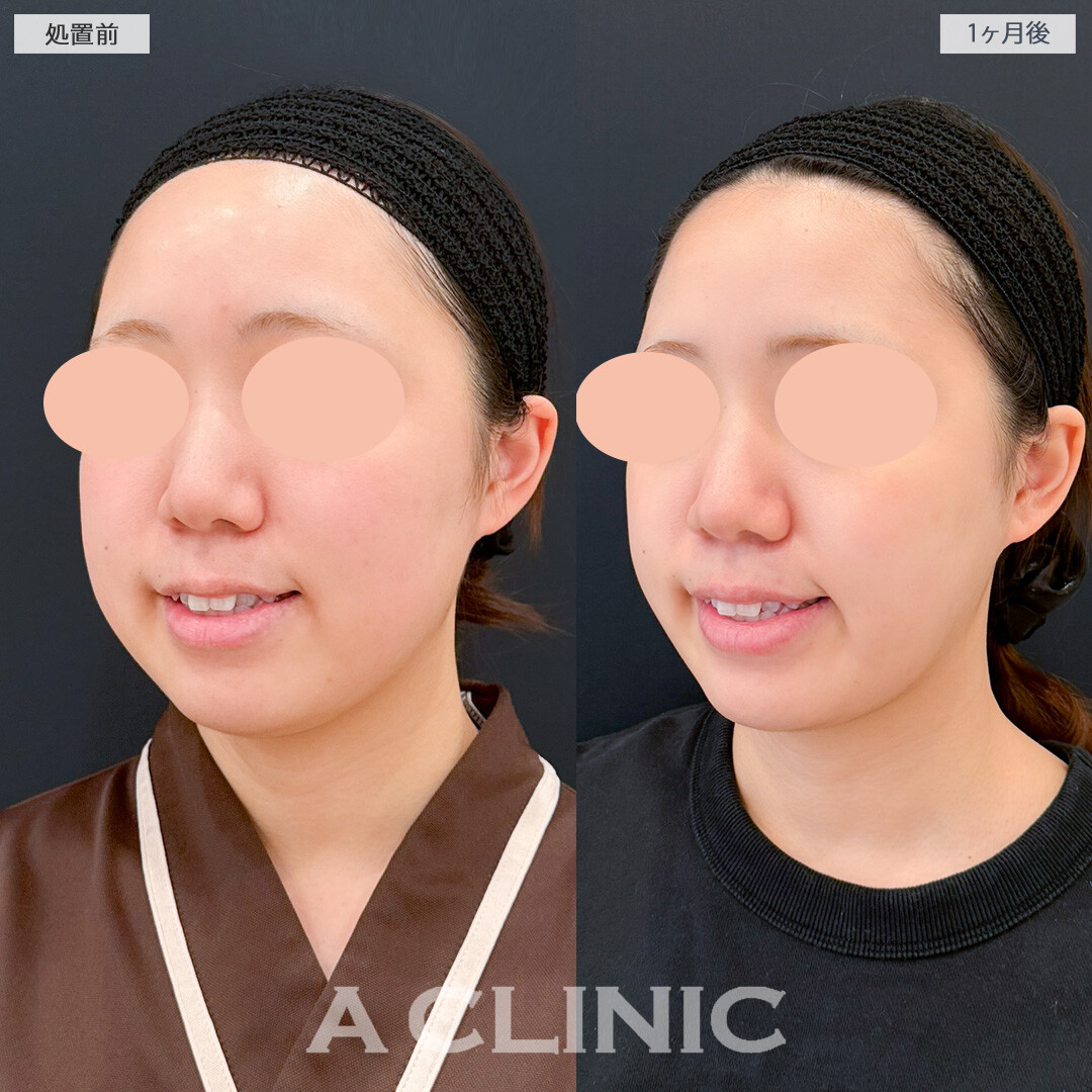 1day小顔脂肪吸引とバッカルファット除去術で口横の膨らみを抑えて小顔効果抜群！処置前と1ヶ月後の症例です(20代女性)
