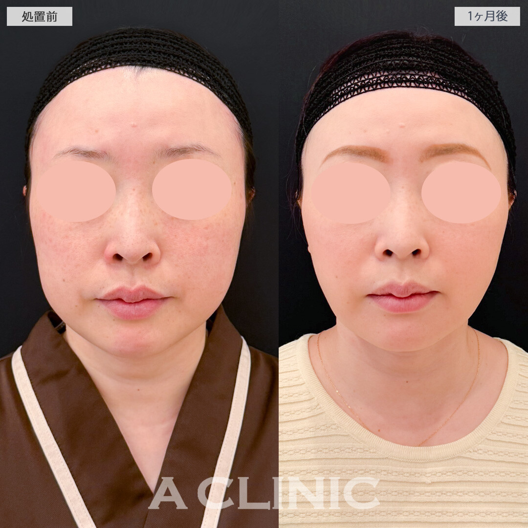 1day小顔脂肪吸引とバッカルファット除去術と小顔エラボトックスで必要な脂肪を残して輪郭の形を整えます！処置前と1ヶ月後の症例です(40代女性)
