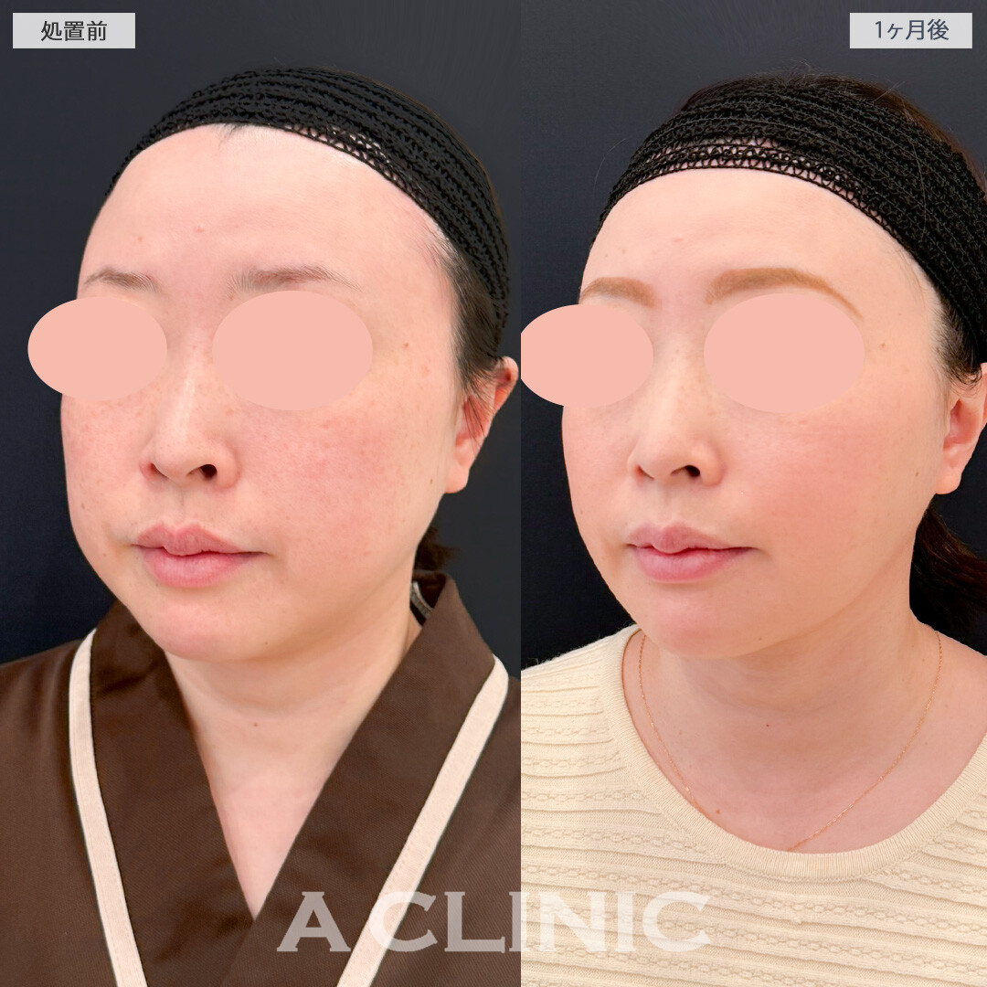 1day小顔脂肪吸引とバッカルファット除去術と小顔エラボトックスで必要な脂肪を残して輪郭の形を整えます！処置前と1ヶ月後の症例です(40代女性)
