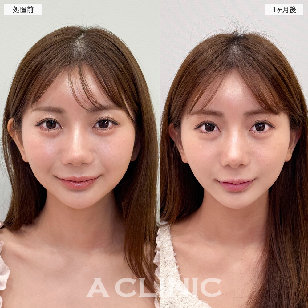 1day小顔脂肪吸引とバッカルファット除去術で中顔面短縮してさらに小顔になれちゃいました！こちら処置前と1ヶ月後の症例です(20代女性)