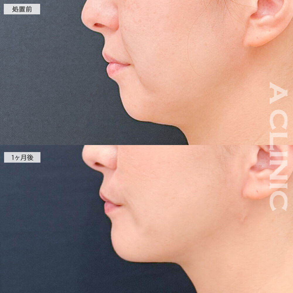 1day小顔脂肪吸引とあごへのヒアルロン酸注入とあごのボトックス注射でどこから見ても整った印象になりました！こちら処置前から2ヶ月後の症例です(40代女性)