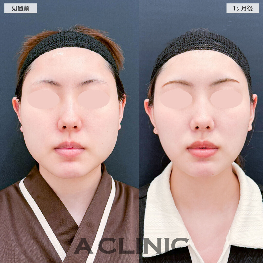1day小顔脂肪吸引と小顔エラボトックスでお顔全体のボリュームが減りました！処置前から2ヶ月後の症例です(20代女性)
