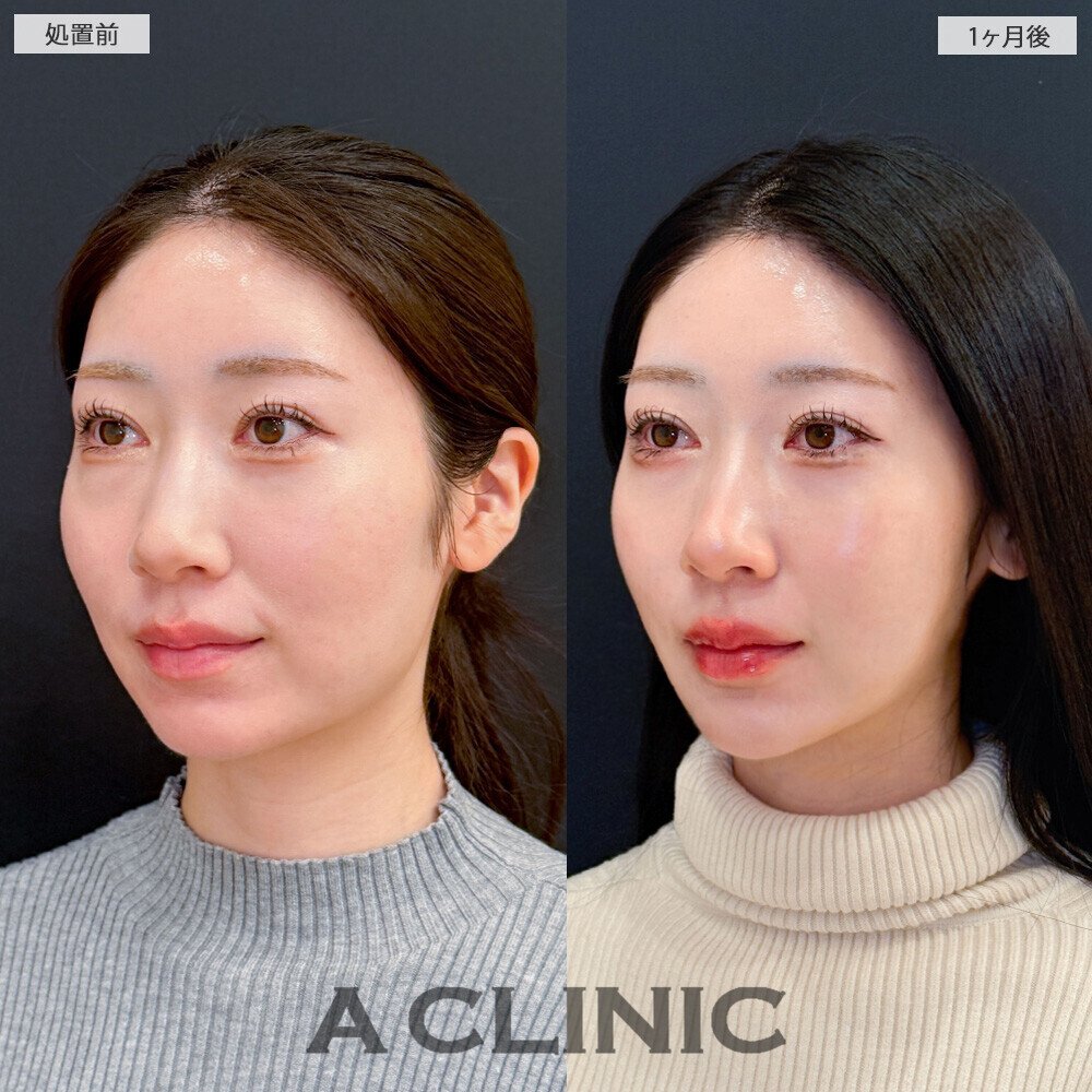 1day小顔脂肪吸引で丸顔が改善されることで大人っぽい雰囲気に！こちら処置前から1ヶ月後の症例です(20代女性)