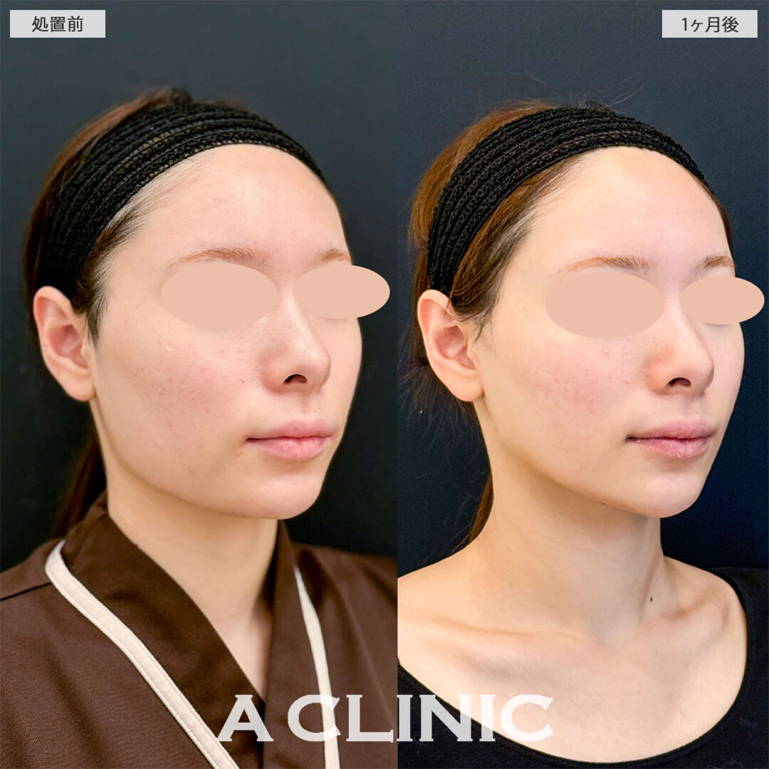 1day小顔脂肪吸引と小顔エラボトックスで左右差もなくなり綺麗な卵形輪郭へ！こちら処置前と1ヶ月後の症例です(20代女性)