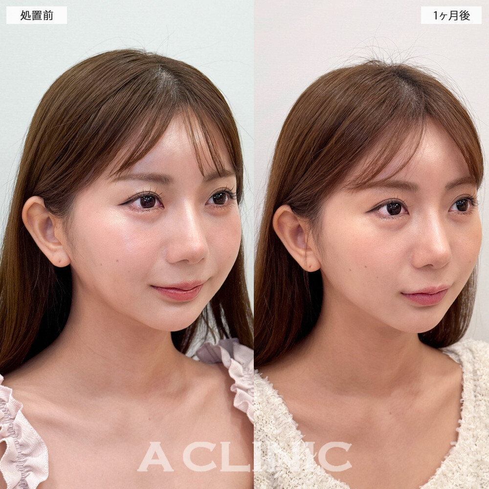 1day小顔脂肪吸引とバッカルファット除去術で中顔面短縮してさらに小顔になれちゃいました！こちら処置前と1ヶ月後の症例です(20代女性)