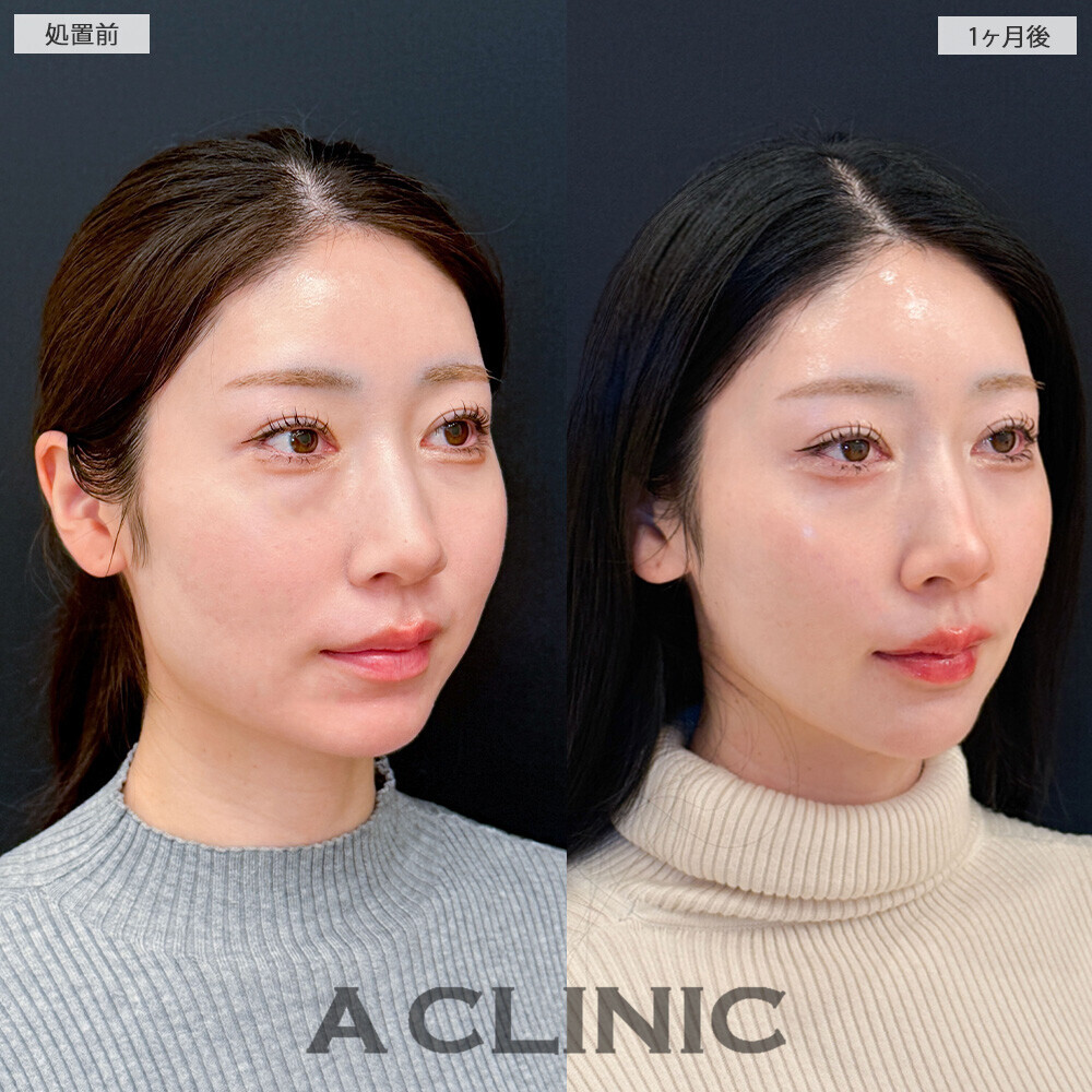 1day小顔脂肪吸引で丸顔が改善されることで大人っぽい雰囲気に！こちら処置前から1ヶ月後の症例です(20代女性)