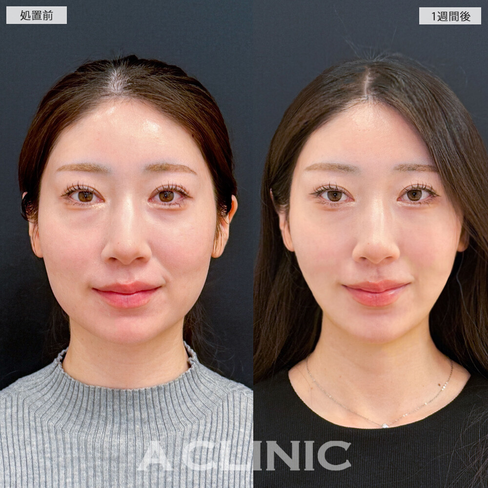 1day小顔脂肪吸引で丸顔が改善されることで大人っぽい雰囲気に！こちら処置前から1ヶ月後の症例です(20代女性)