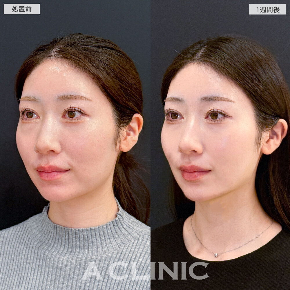 1day小顔脂肪吸引で丸顔が改善されることで大人っぽい雰囲気に！こちら処置前から1ヶ月後の症例です(20代女性)