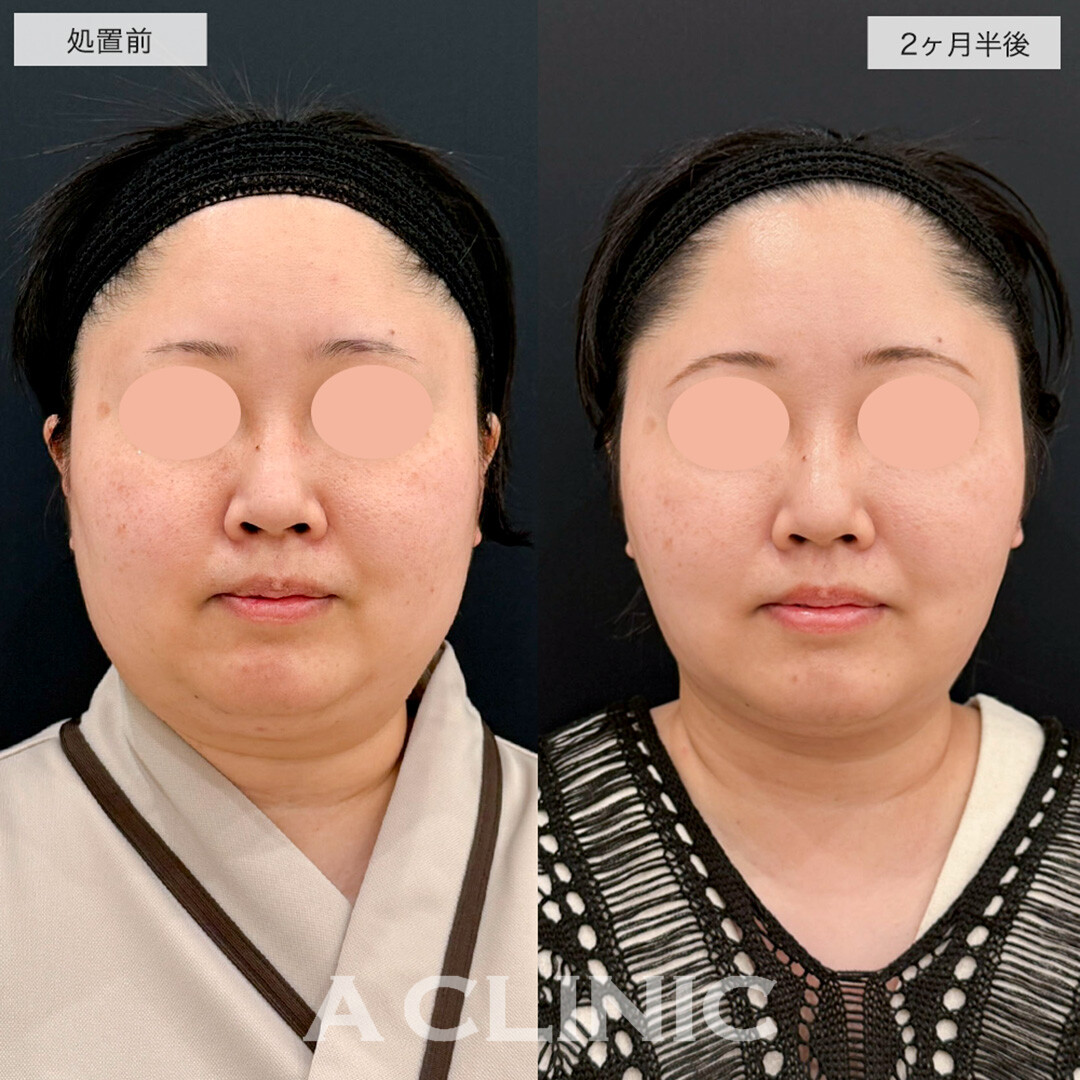 1day小顔脂肪吸引で一回り顔が小さくなり卵形の輪郭に近づきました!こちら処置前と2.5ヶ月後の症例です(30代女性)