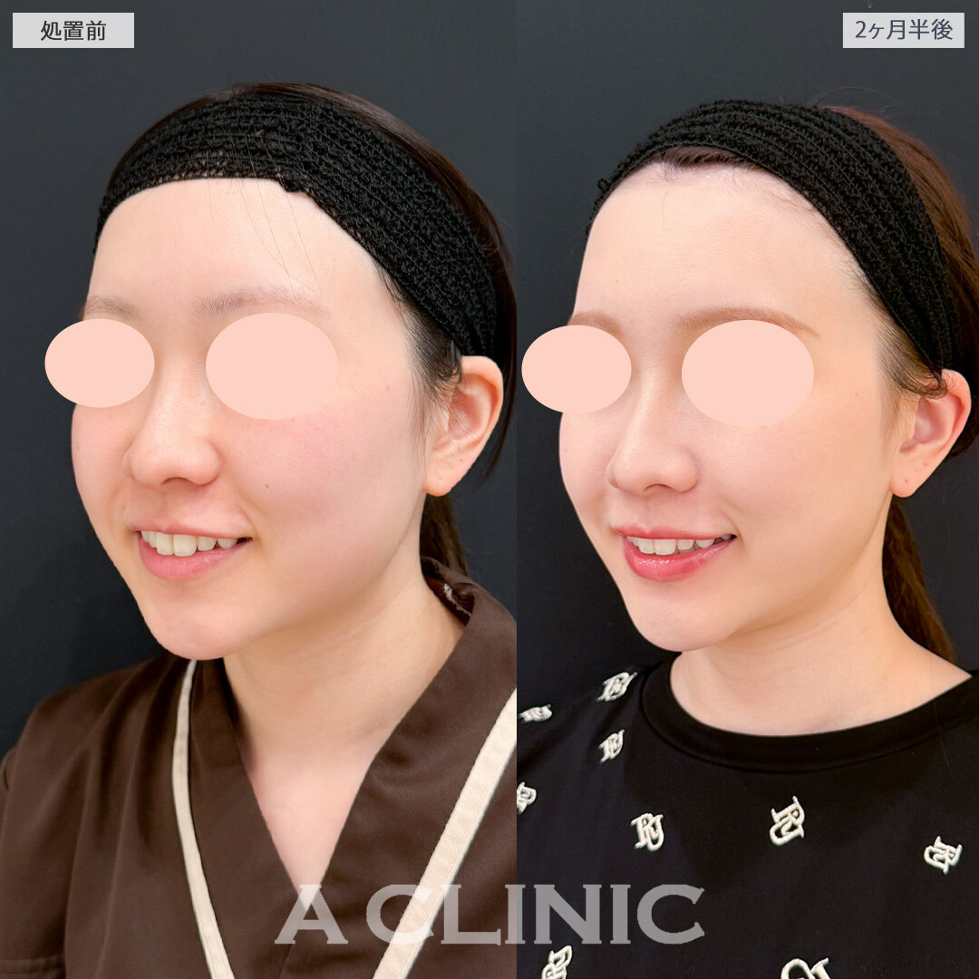 1day小顔脂肪吸引とバッカルファット除去術で口横のボリュームダウンに成功！処置前と2ヶ月半後の症例です(20代女性)