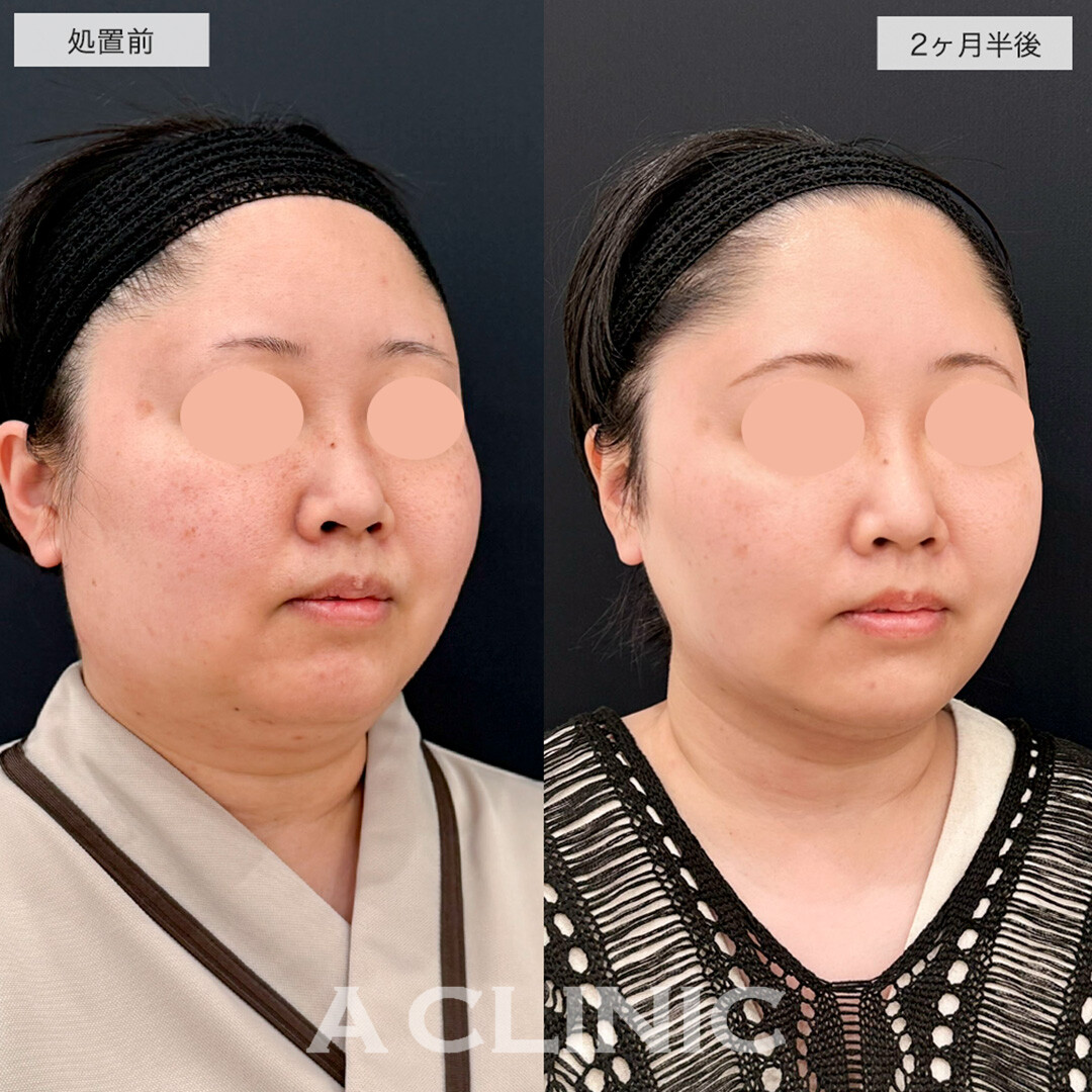 1day小顔脂肪吸引で一回り顔が小さくなり卵形の輪郭に近づきました!こちら処置前と2.5ヶ月後の症例です(30代女性)