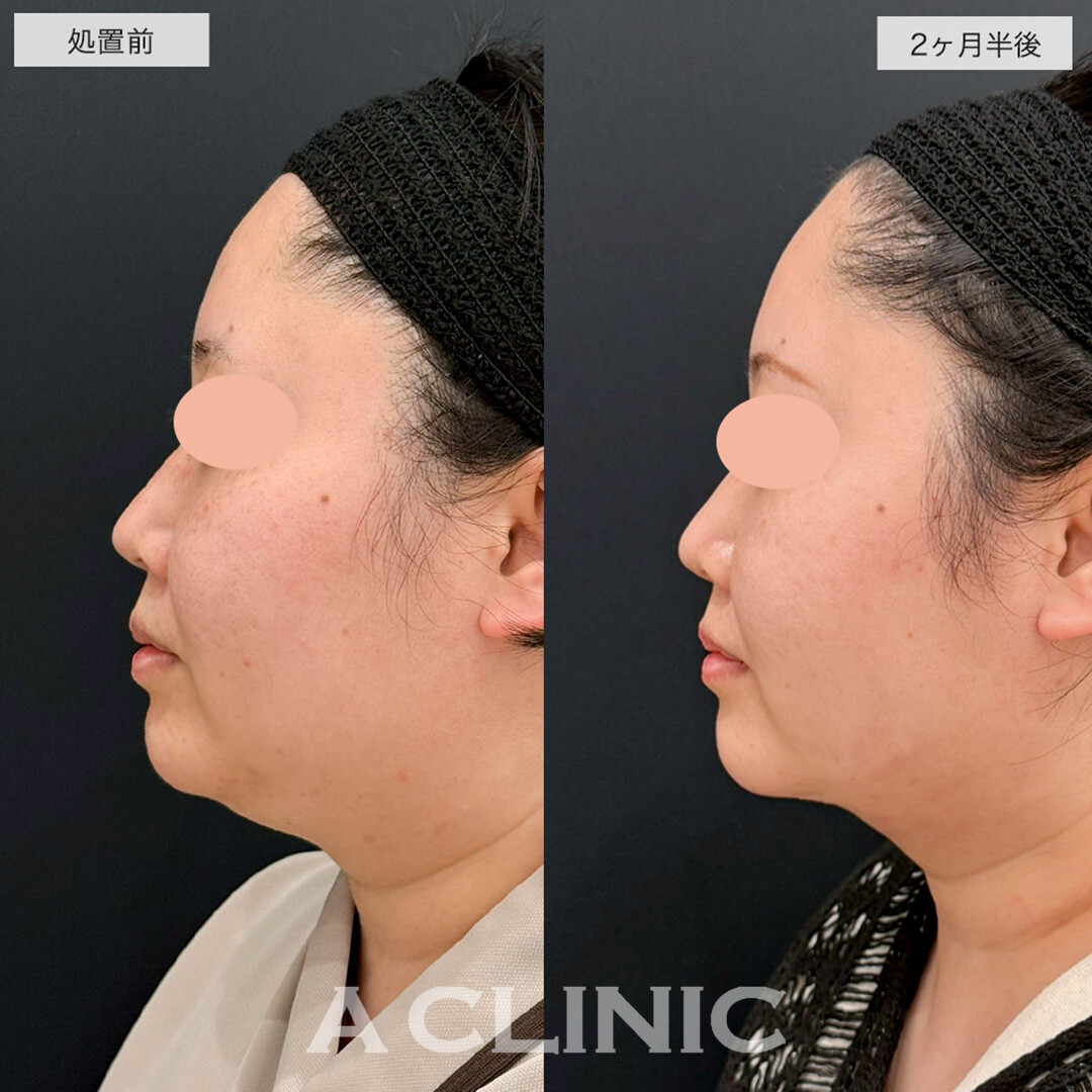 1day小顔脂肪吸引で一回り顔が小さくなり卵形の輪郭に近づきました!こちら処置前と2.5ヶ月後の症例です(30代女性)