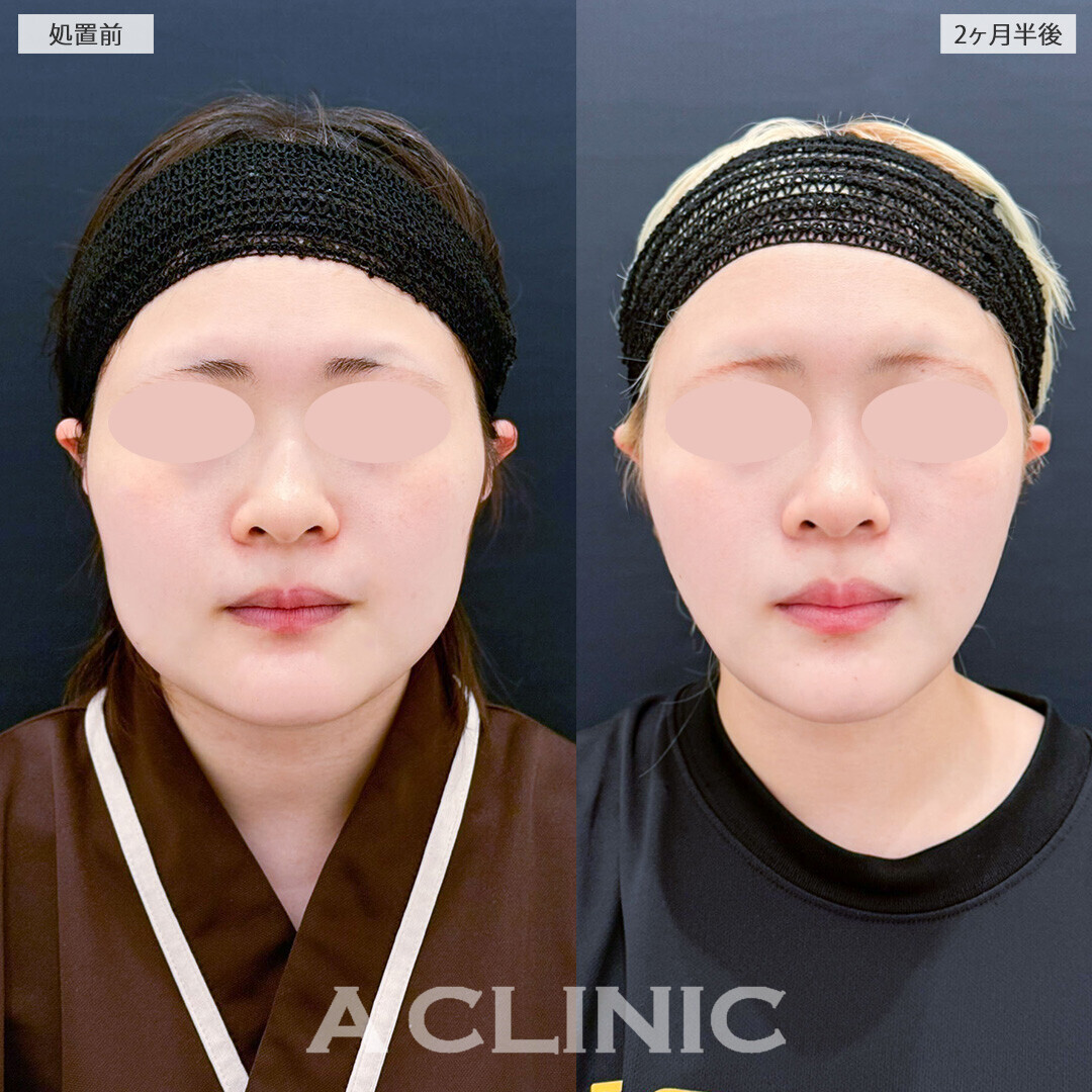 1day小顔脂肪吸引と小顔エラボトックスで顔の横幅が減りました！こちら処置前から2ヶ月半後の症例です(20代女性)