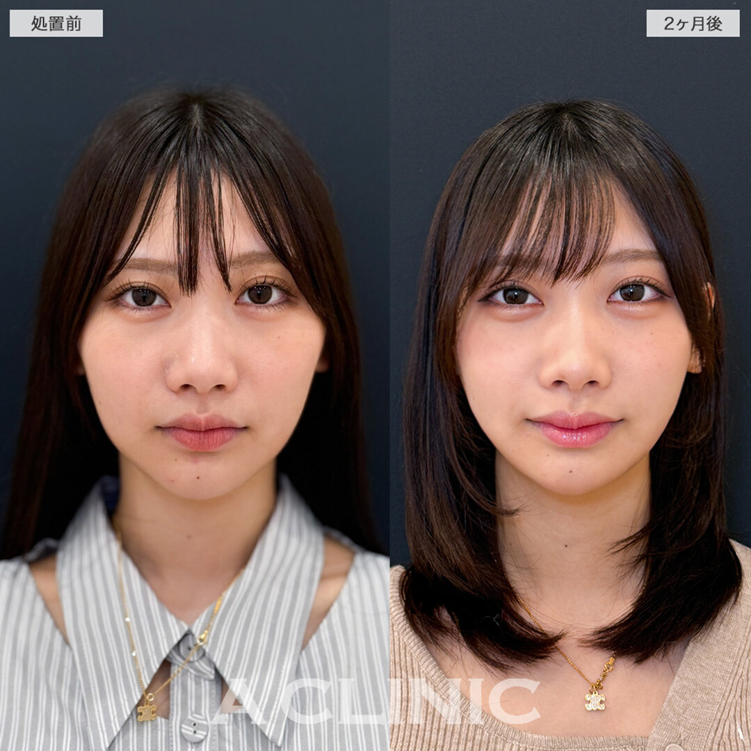 1day小顔脂肪吸引で左右差解消し理想のVフェイスになれました！こちら処置前と2ヶ月後の症例です(20代女性)