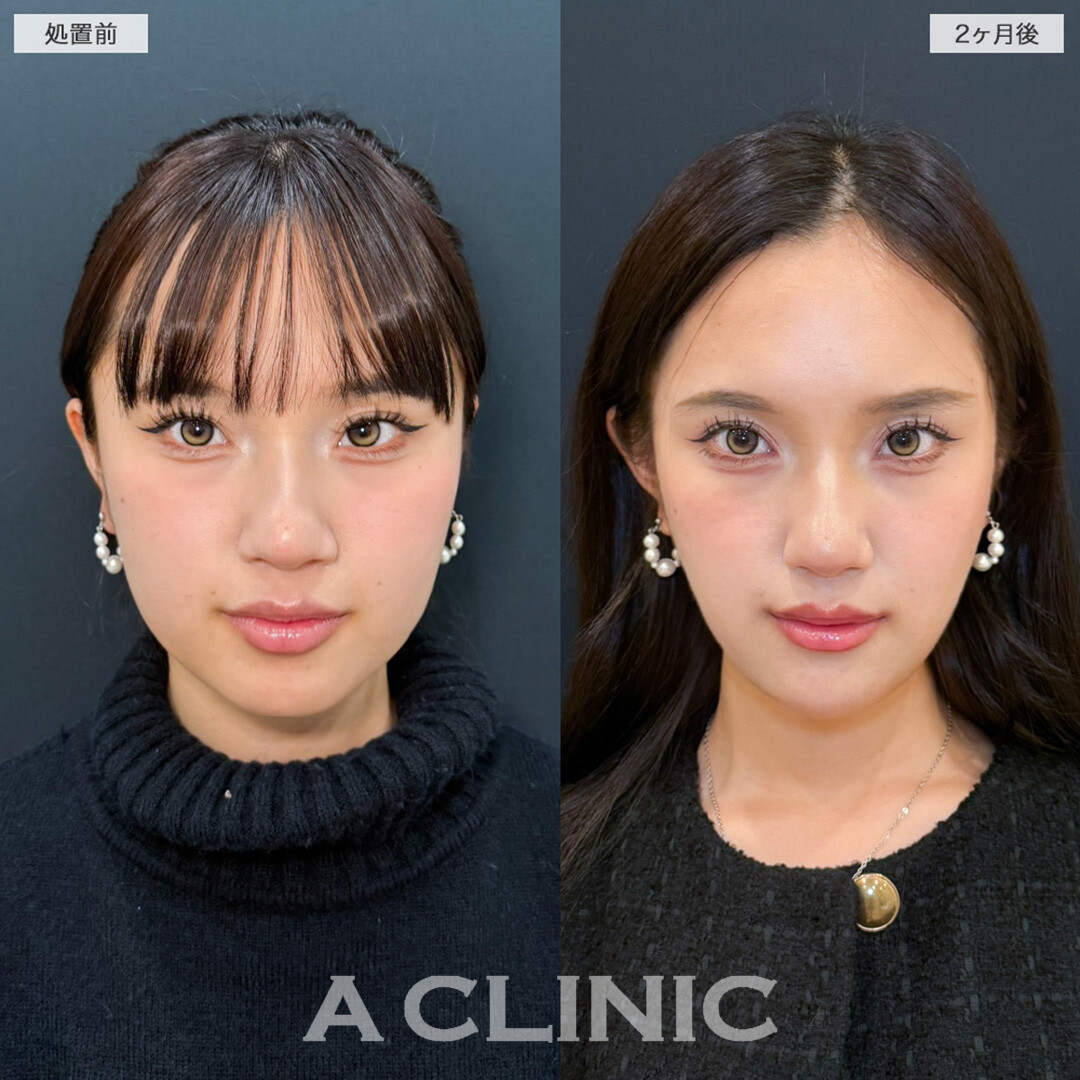 1day小顔脂肪吸引と小顔エラボトックスで輪郭を滑らかに整え大人な印象へ！こちら処置前と2ヶ月後の症例です(20代女性)