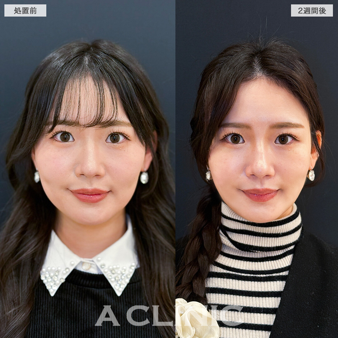 1day小顔脂肪吸引で体重は変わらないのに痩せたと言われる自然で確かな変化へ！こちら処置前と2週間後の症例です(20代女性)