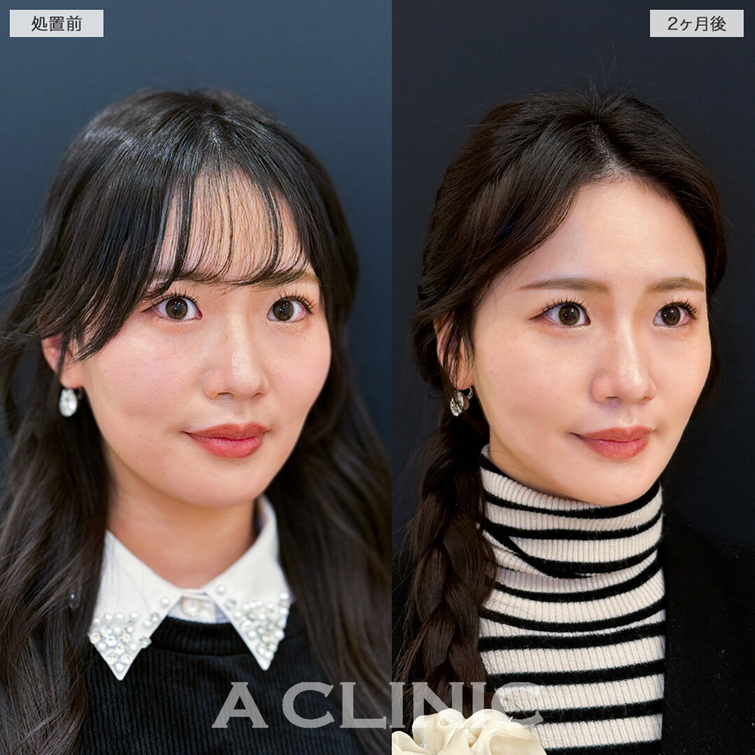 1day小顔脂肪吸引で体重は変わらないのに痩せたと言われる自然で確かな変化へ！こちら処置前と2ヶ月後の症例です(20代女性)