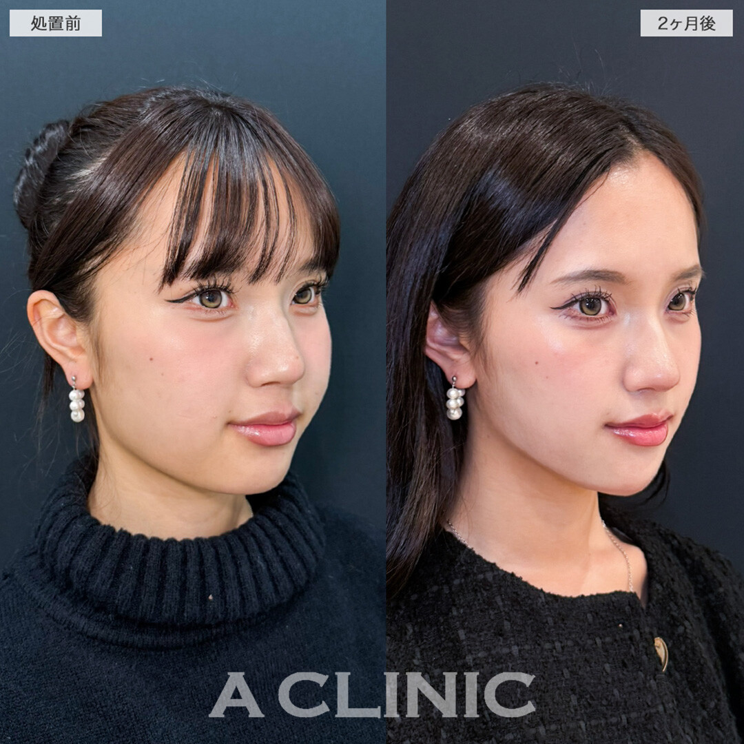 1day小顔脂肪吸引と小顔エラボトックスで輪郭を滑らかに整え大人な印象へ！こちら処置前と2ヶ月後の症例です(20代女性)