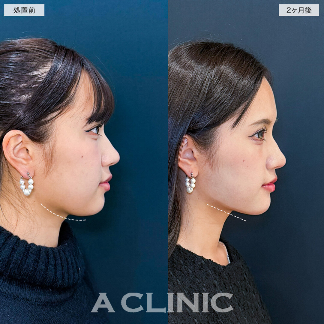 1day小顔脂肪吸引と小顔エラボトックスで輪郭を滑らかに整え大人な印象へ！こちら処置前と2ヶ月後の症例です(20代女性)