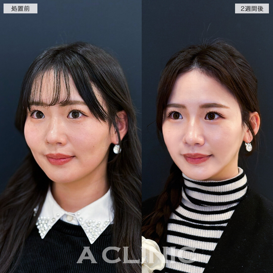 1day小顔脂肪吸引で体重は変わらないのに痩せたと言われる自然で確かな変化へ！こちら処置前と2週間後の症例です(20代女性)