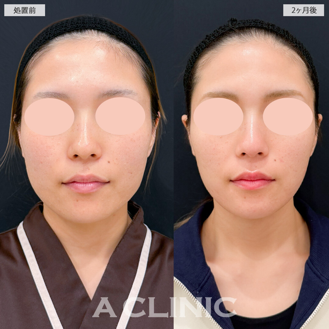 1day小顔脂肪吸引と小顔エラボトックスで四角い輪郭もシャープな輪郭に修正できました！処置前と2ヶ月後の症例です(20代女性)