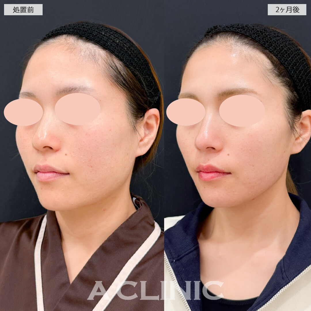 1day小顔脂肪吸引と小顔エラボトックスで四角い輪郭もシャープな輪郭に修正できました！処置前と2ヶ月後の症例です(20代女性)