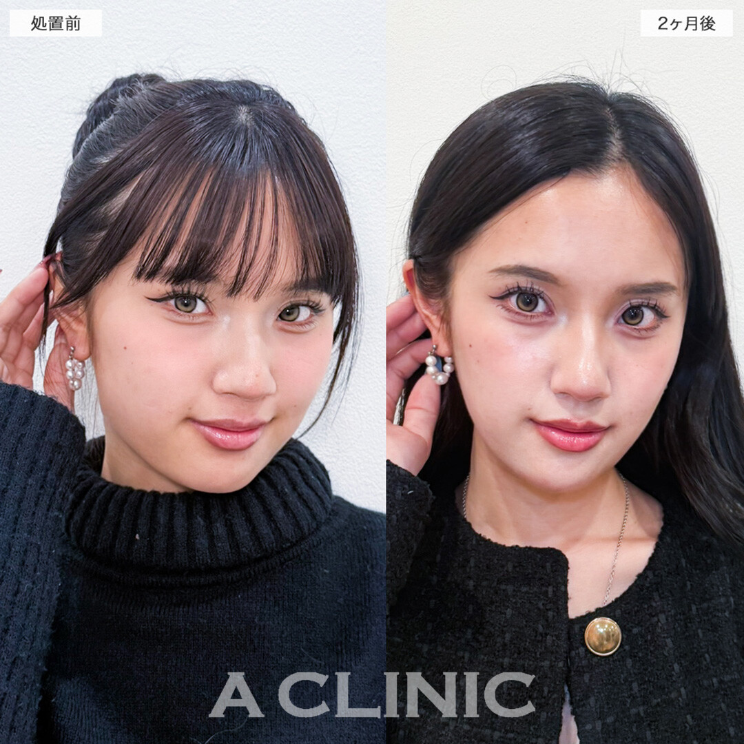 1day小顔脂肪吸引と小顔エラボトックスで輪郭を滑らかに整え大人な印象へ！こちら処置前と2ヶ月後の症例です(20代女性)