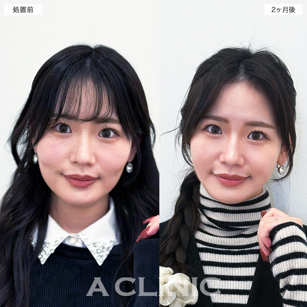 1day小顔脂肪吸引で体重は変わらないのに痩せたと言われる自然で確かな変化へ！こちら処置前と2ヶ月後の症例です(20代女性)