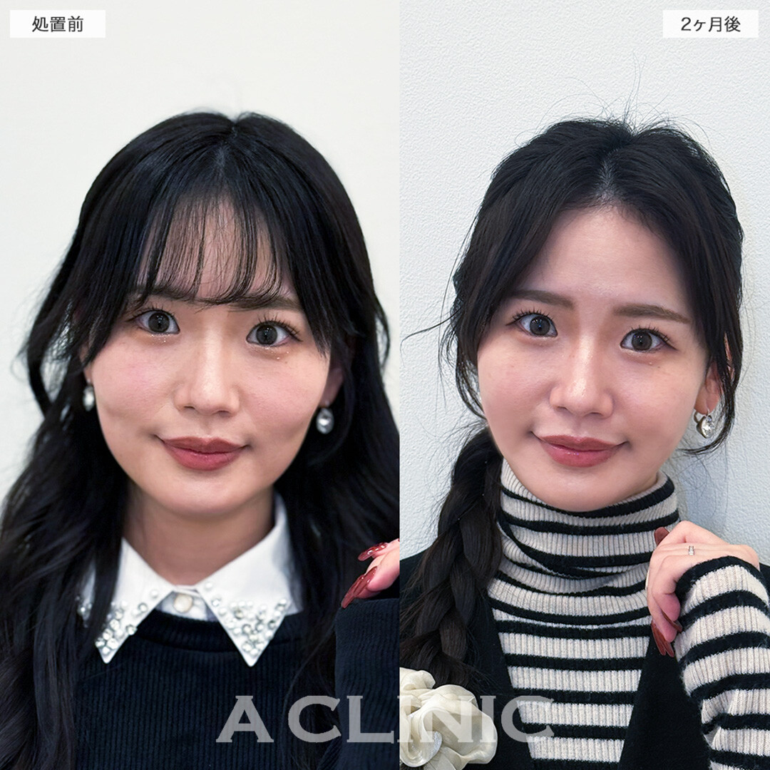 1day小顔脂肪吸引で体重は変わらないのに痩せたと言われる自然で確かな変化へ！こちら処置前と2ヶ月後の症例です(20代女性)