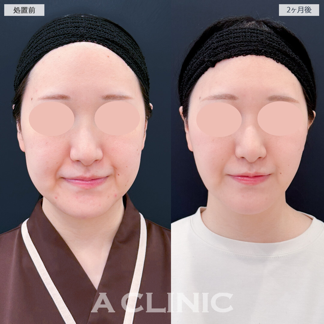 1day小顔脂肪吸引と小顔エラボトックスで2ヶ月後はよりスッキリ感を実感できるようになりました！処置前と2ヶ月後の症例です(30代女性)