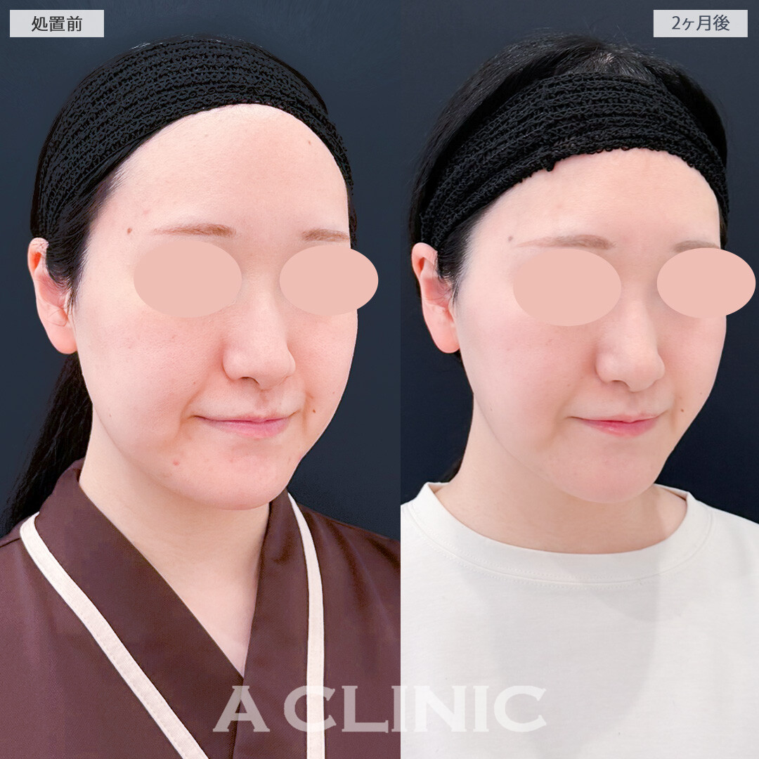 1day小顔脂肪吸引と小顔エラボトックスで2ヶ月後はよりスッキリ感を実感できるようになりました！処置前と2ヶ月後の症例です(30代女性)