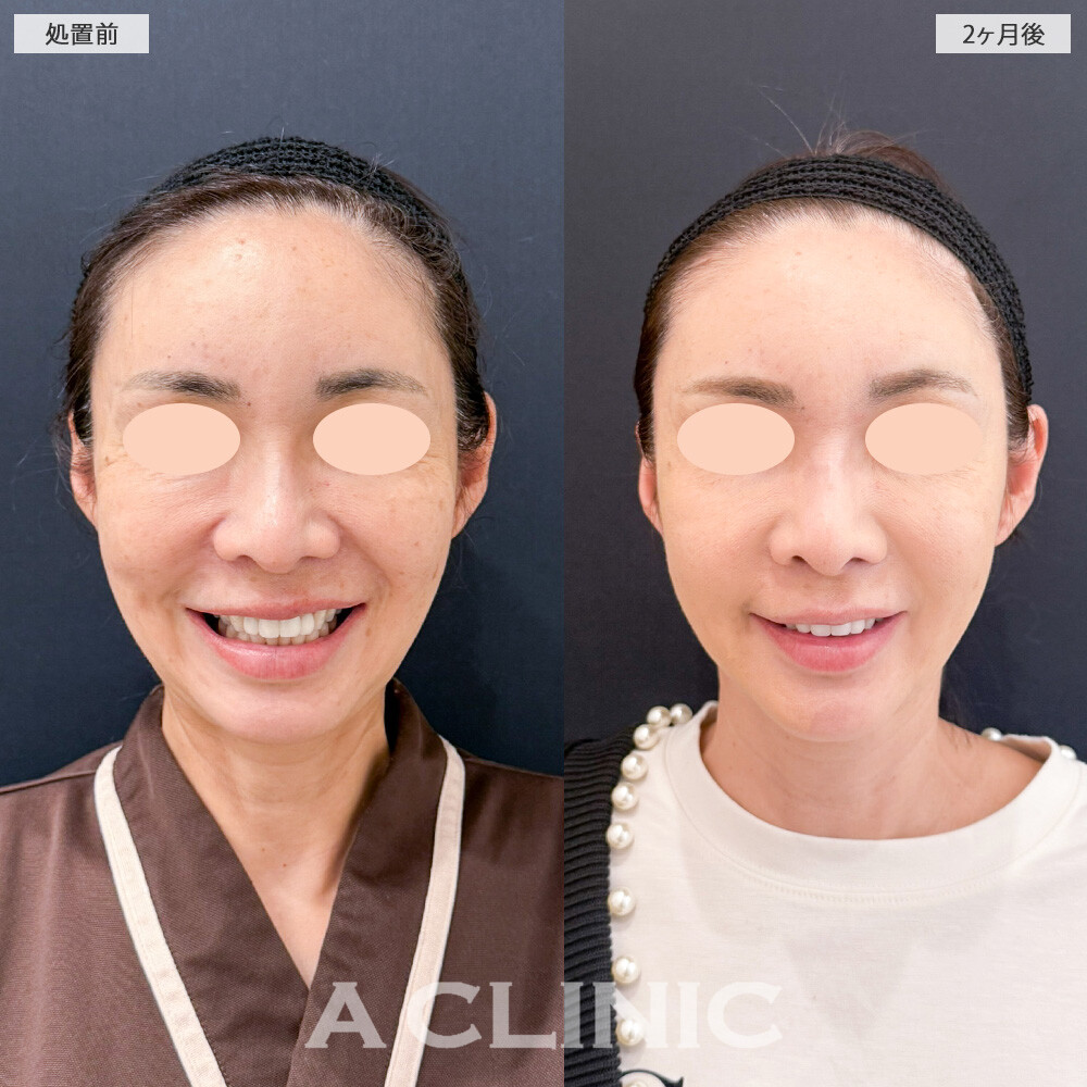 1day小顔脂肪吸引で気になる脂肪だけを取り除いて、コケることなくスッキリとした小顔になりました！こちら処置前と2ヶ月後の症例です(50代女性)