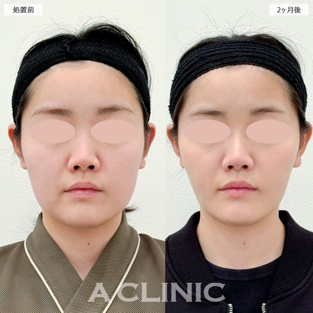 1day小顔脂肪吸引と小顔エラボトックスで吸引部位が少なくてもしっかり小顔に！こちら処置前と2ヶ月後の症例です(20代女性)