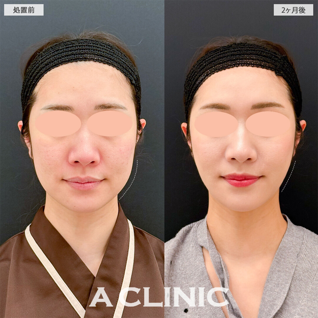 1day小顔脂肪吸引と小顔エラボトックスでどの角度から見ても綺麗な輪郭になりました！こちら処置前と2ヶ月後の症例です(20代女性)