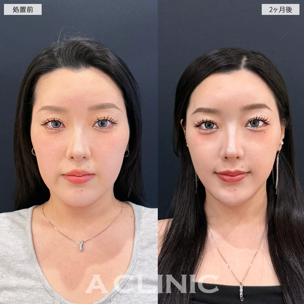 1day小顔脂肪吸引で輪郭に凹凸の無い綺麗なフェイスラインに整いました！こちら処置前と2ヶ月後の症例です(20代女性)