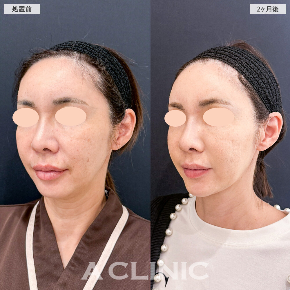 1day小顔脂肪吸引で気になる脂肪だけを取り除いて、コケることなくスッキリとした小顔になりました！こちら処置前と2ヶ月後の症例です(50代女性)