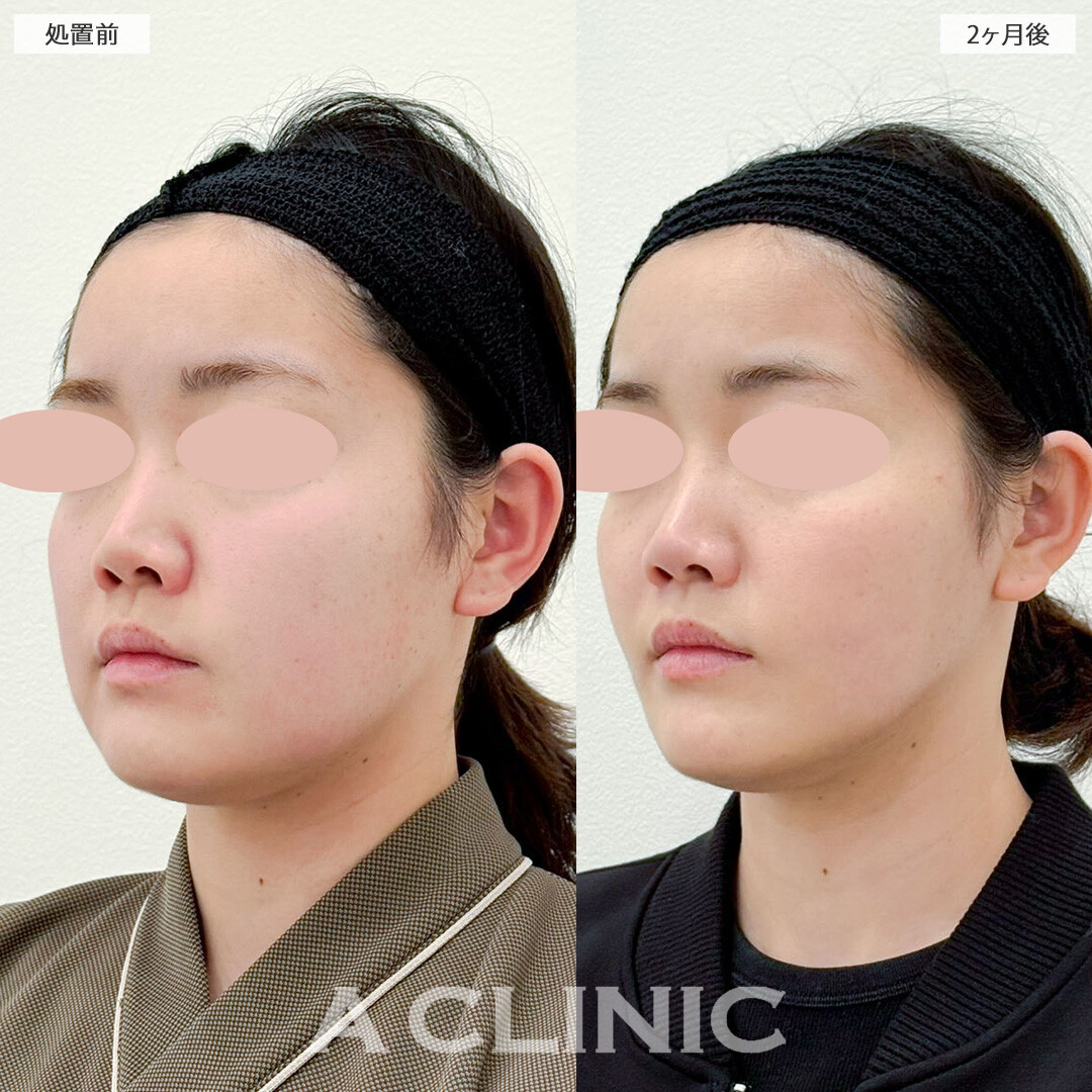1day小顔脂肪吸引と小顔エラボトックスで吸引部位が少なくてもしっかり小顔に！こちら処置前と2ヶ月後の症例です(20代女性)