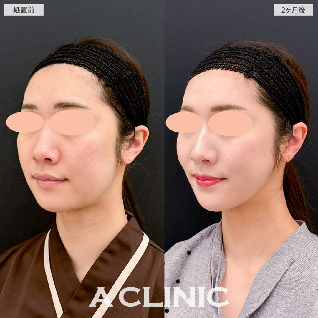 1day小顔脂肪吸引と小顔エラボトックスでどの角度から見ても綺麗な輪郭になりました！こちら処置前と2ヶ月後の症例です(20代女性)