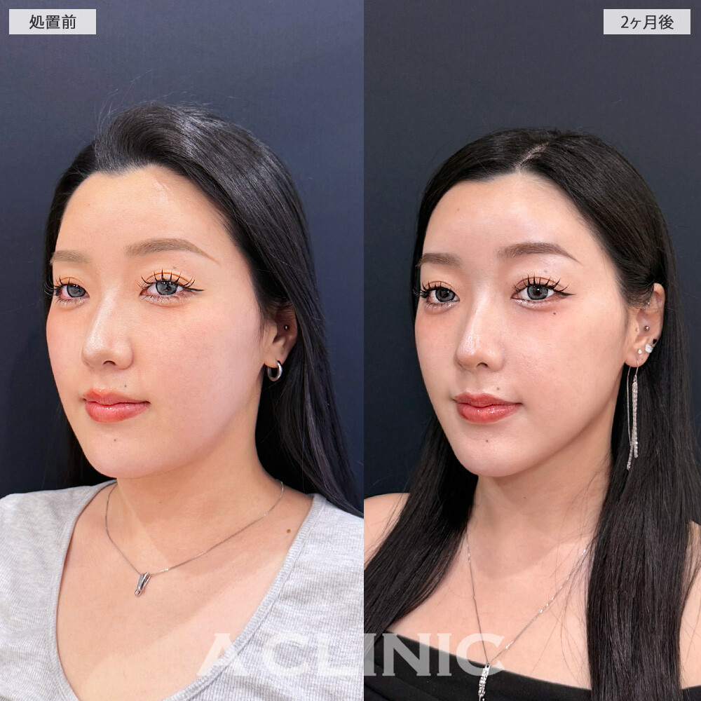 1day小顔脂肪吸引で輪郭に凹凸の無い綺麗なフェイスラインに整いました！こちら処置前と2ヶ月後の症例です(20代女性)