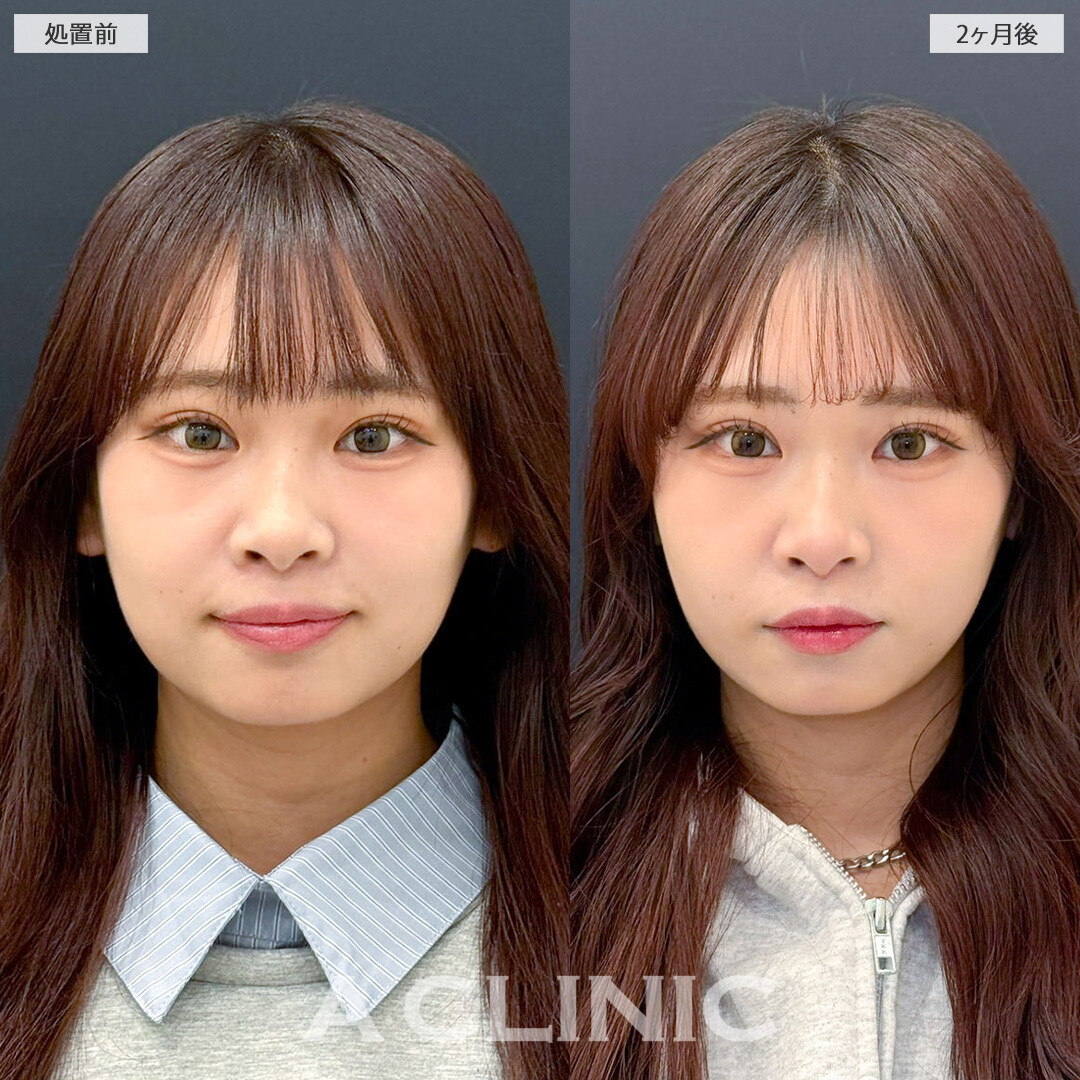 1day小顔脂肪吸引で顔が一回りも小さく！こちら処置前と2ヶ月後の症例です(20代女性)