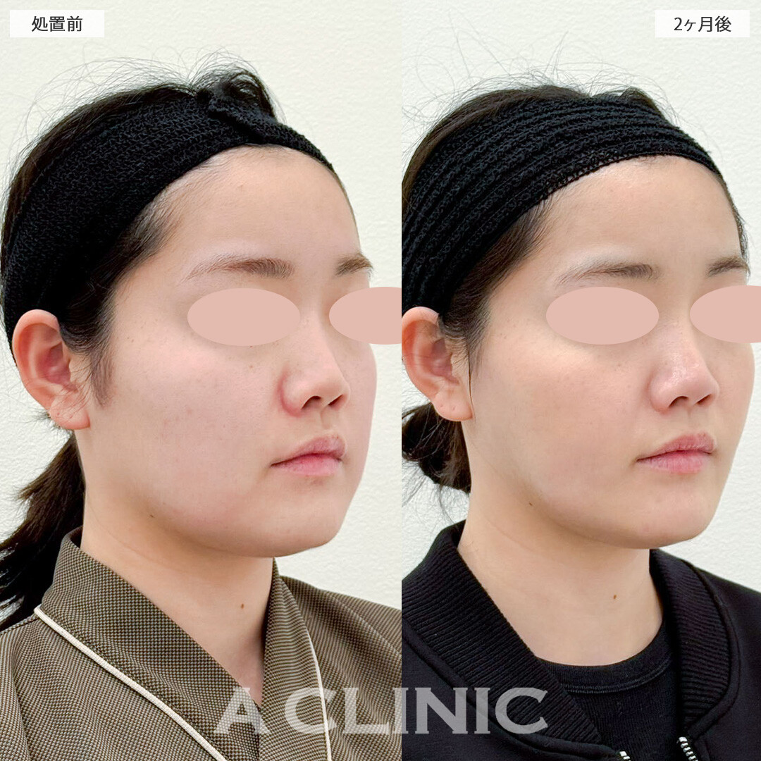 1day小顔脂肪吸引と小顔エラボトックスで吸引部位が少なくてもしっかり小顔に！こちら処置前と2ヶ月後の症例です(20代女性)