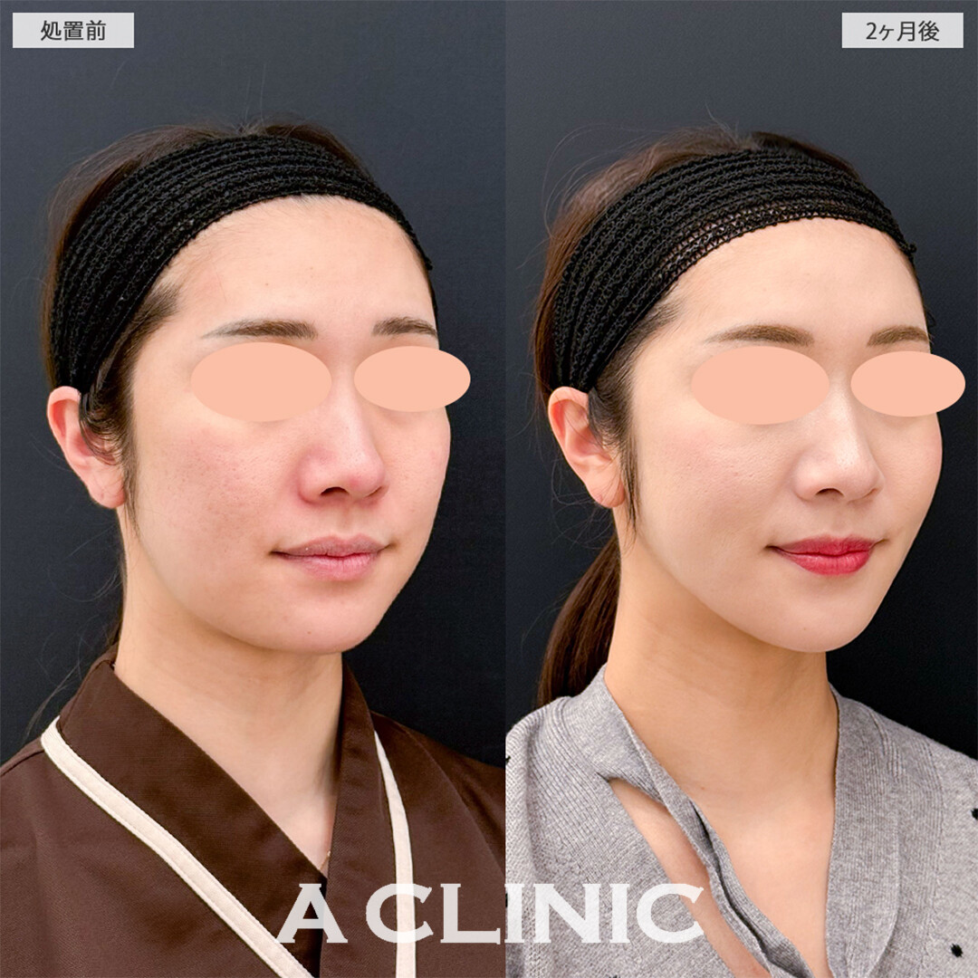 1day小顔脂肪吸引と小顔エラボトックスでどの角度から見ても綺麗な輪郭になりました！こちら処置前と2ヶ月後の症例です(20代女性)