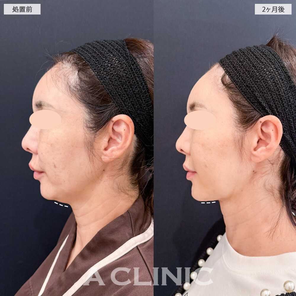 1day小顔脂肪吸引で気になる脂肪だけを取り除いて、コケることなくスッキリとした小顔になりました！こちら処置前と2ヶ月後の症例です(50代女性)