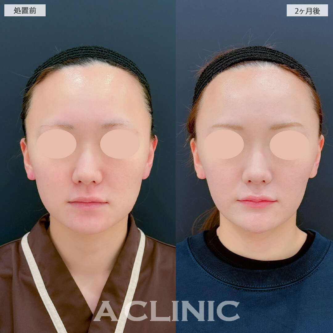 1day小顔脂肪吸引と小顔エラボトックスで余分な脂肪を除去しフェイスラインをしっかり引き上げました！こちら処置前と2ヶ月後の症例です(20代女性)