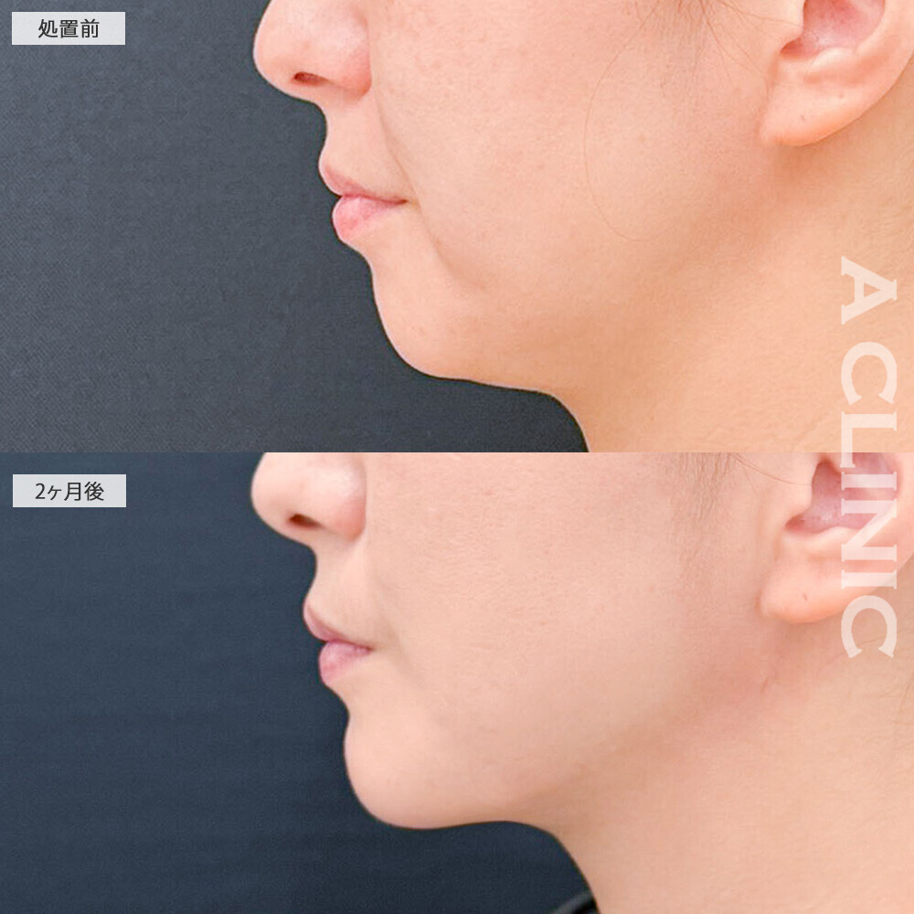 1day小顔脂肪吸引とあごへのヒアルロン酸注入とあごのボトックス注射でどこから見ても整った印象になりました！こちら処置前から2ヶ月後の症例です(40代女性)